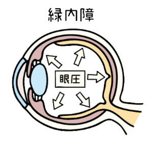 緑内障